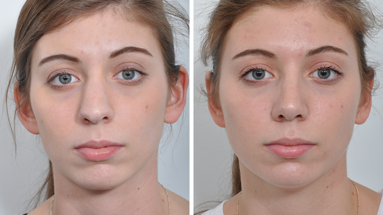 rhinoplasty